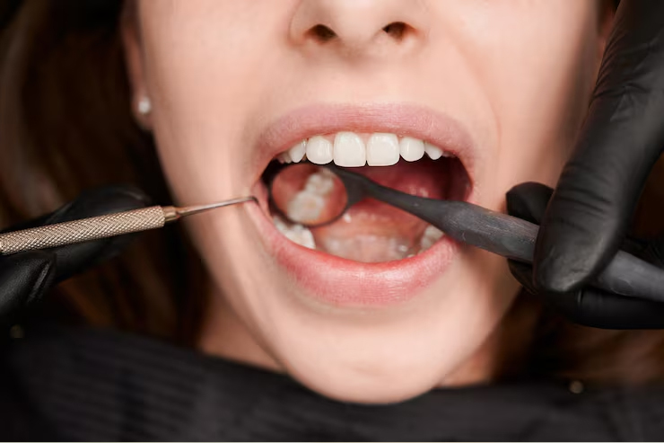 Composite Bonding