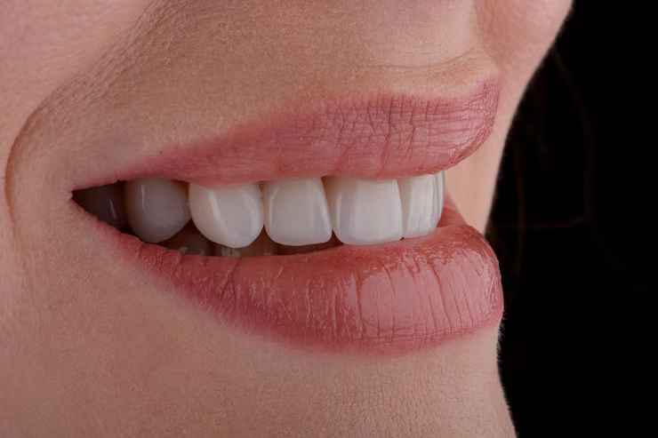 Mock Veneers / Trial Smile