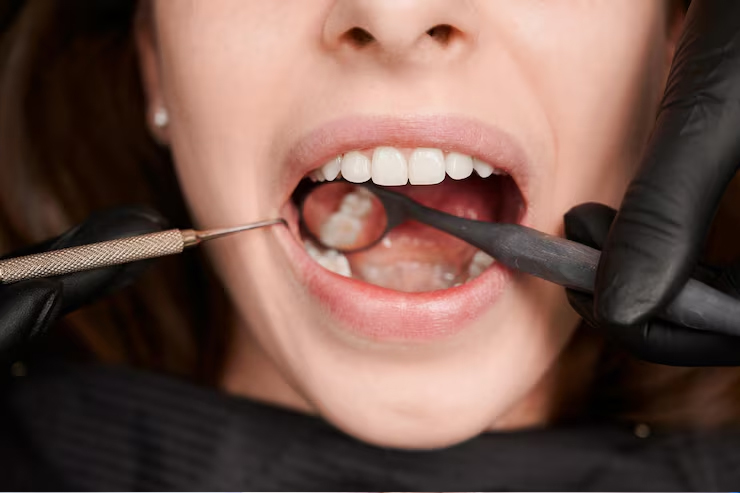 Wisdom Tooth Extraction